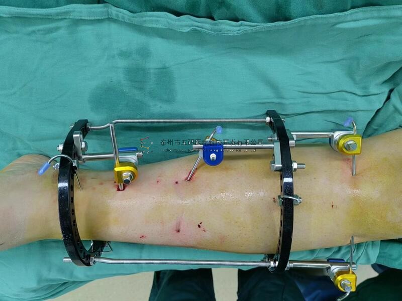 【南陽(yáng)市中醫(yī)院】不開(kāi)刀治骨折病例分享